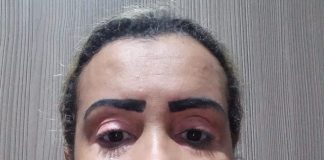 Vitiligo ganha espaço e ajuda combater preconceitos
